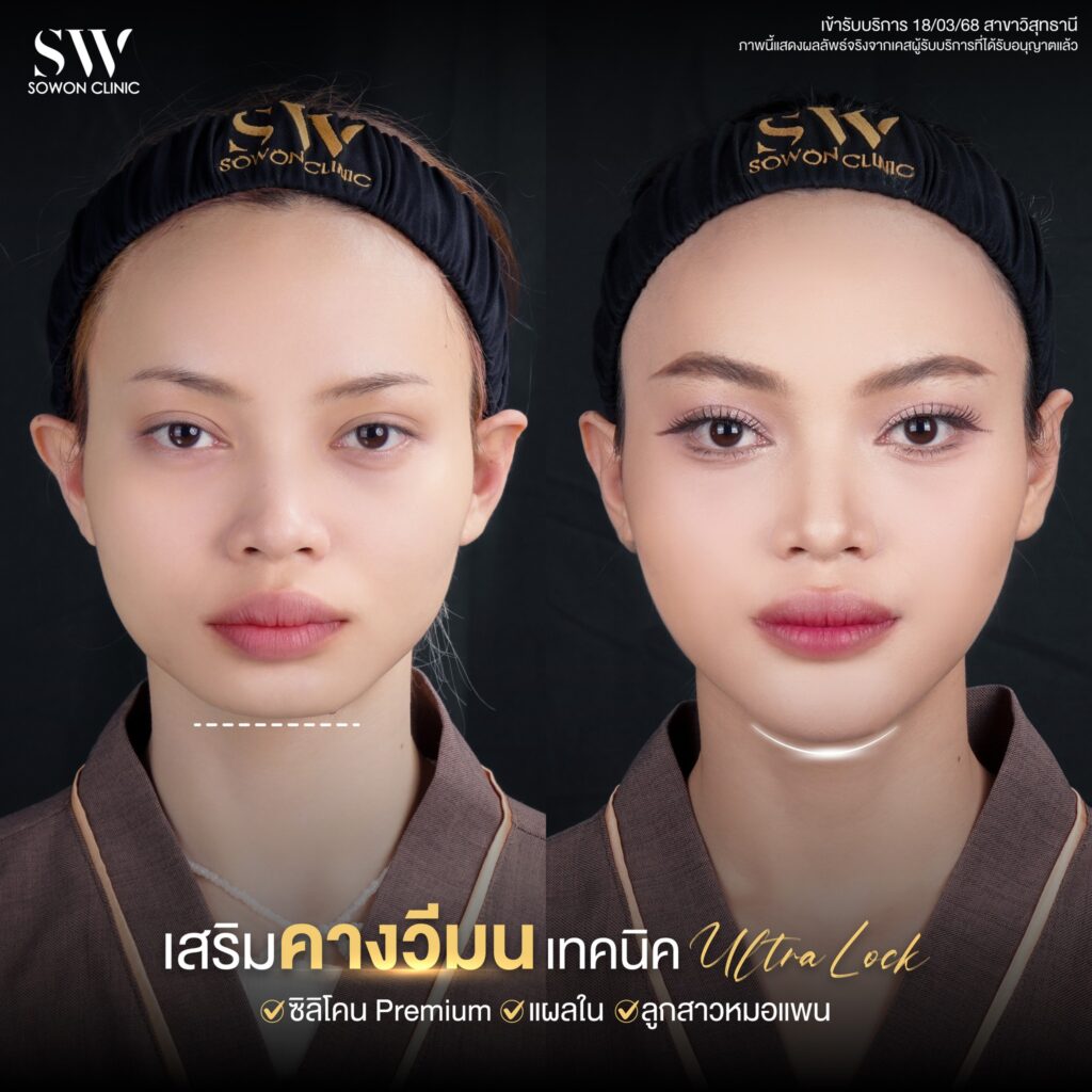 เสริมคาง 09