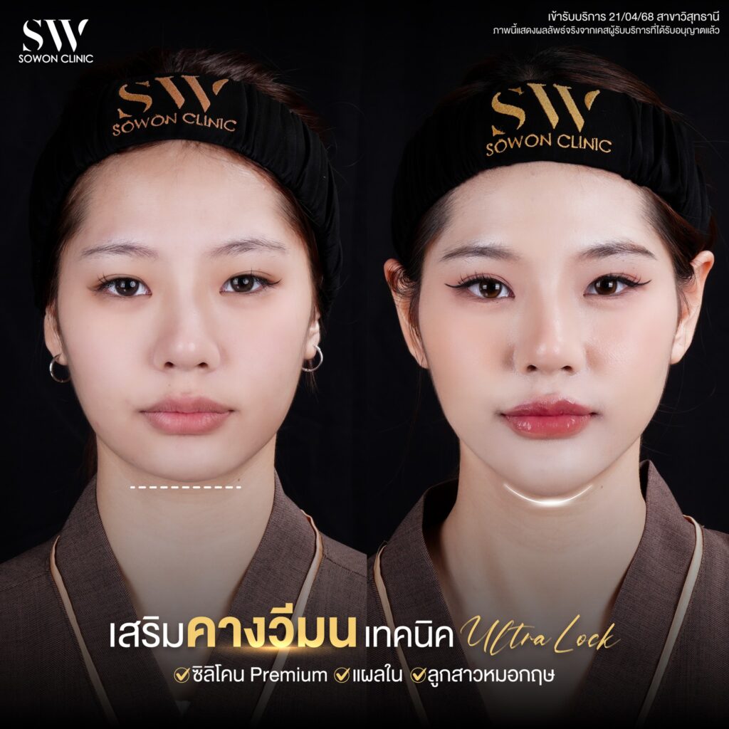 เสริมคาง 10