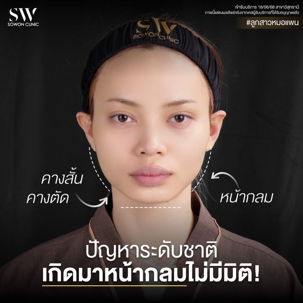 เสริมคาง คุณแป้งหอม 03