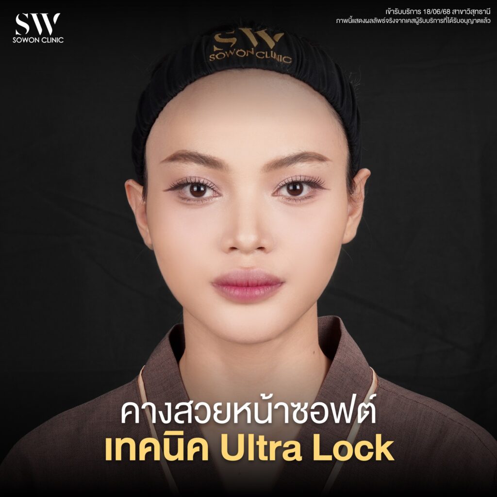 เสริมคาง คุณแป้งหอม 04