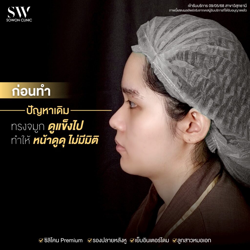 เสริมจมูกครั้งแรก 05