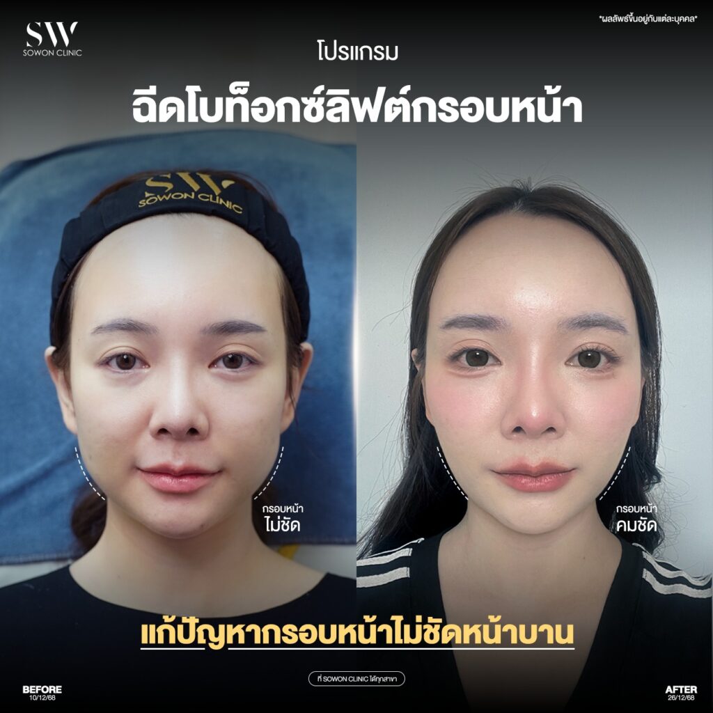 โบท็อกกราม 03