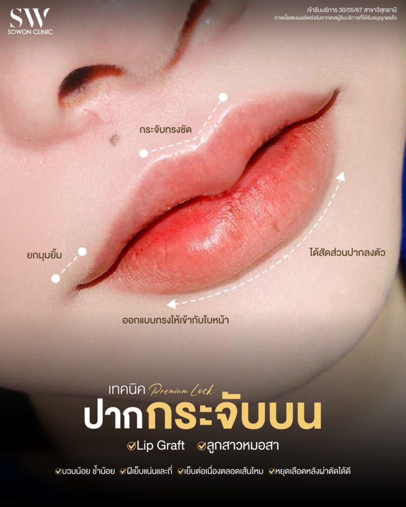 ปากกระจับ vs filler ปาก / ปากกระจับ