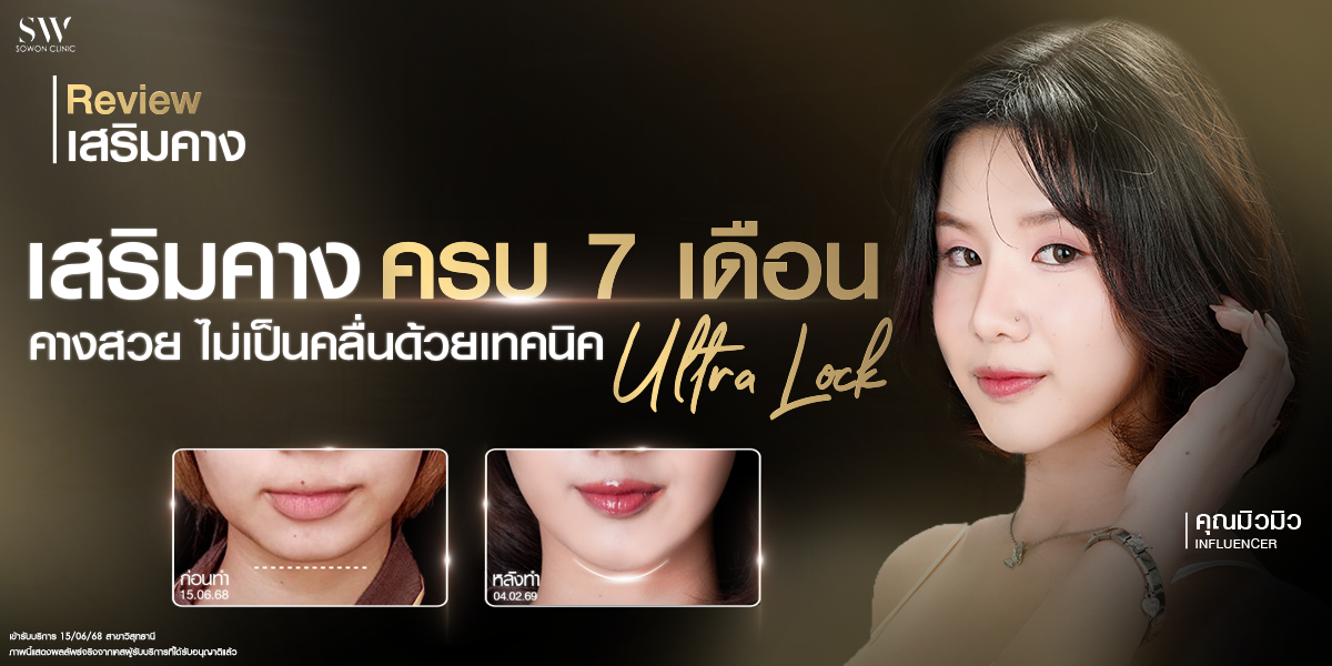 chin-augmentation-7-months-review_surgery-chin_review chin-augmentation-7-months-review_surgery-chin_review