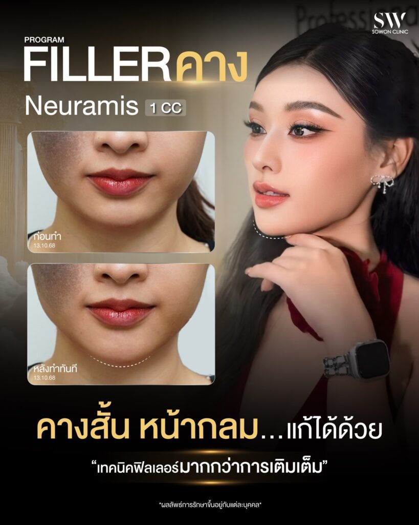 โปรแกรม filler คาง โปรแกรมฟิลเลอร์คาง
