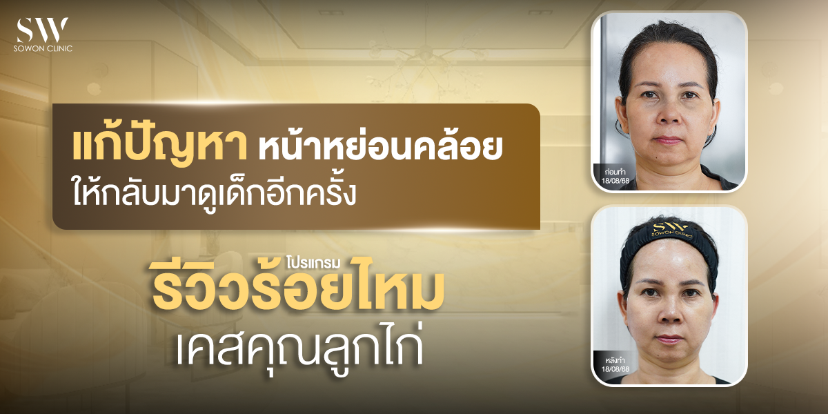 thread-lift-review-for-sagging-skin_skin_thread_review thread-lift-review-for-sagging-skin_skin_thread_review