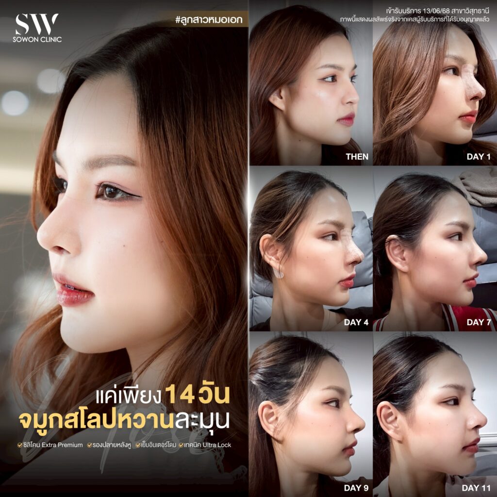 เสริมจมูก