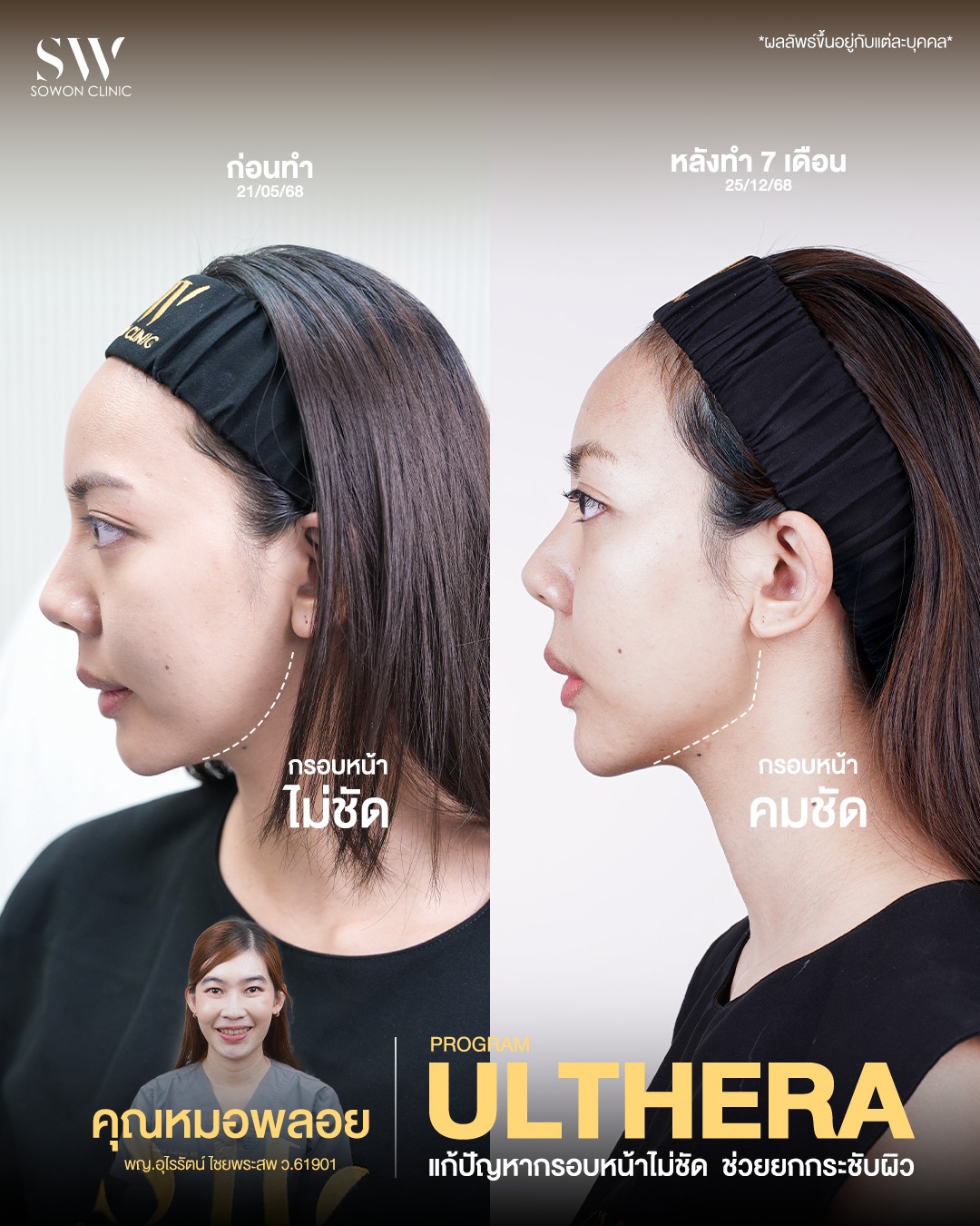 ยกกระชับ Ulthera รีวิว 01