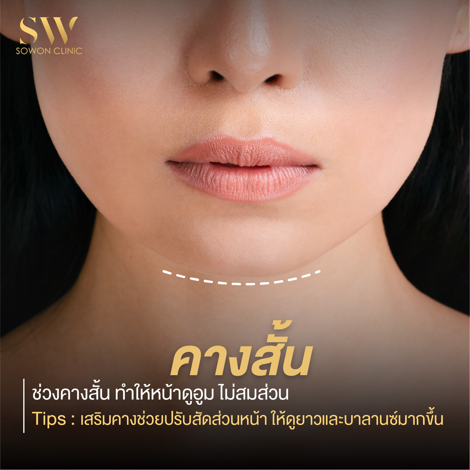 เสริมคาง คางสั้น