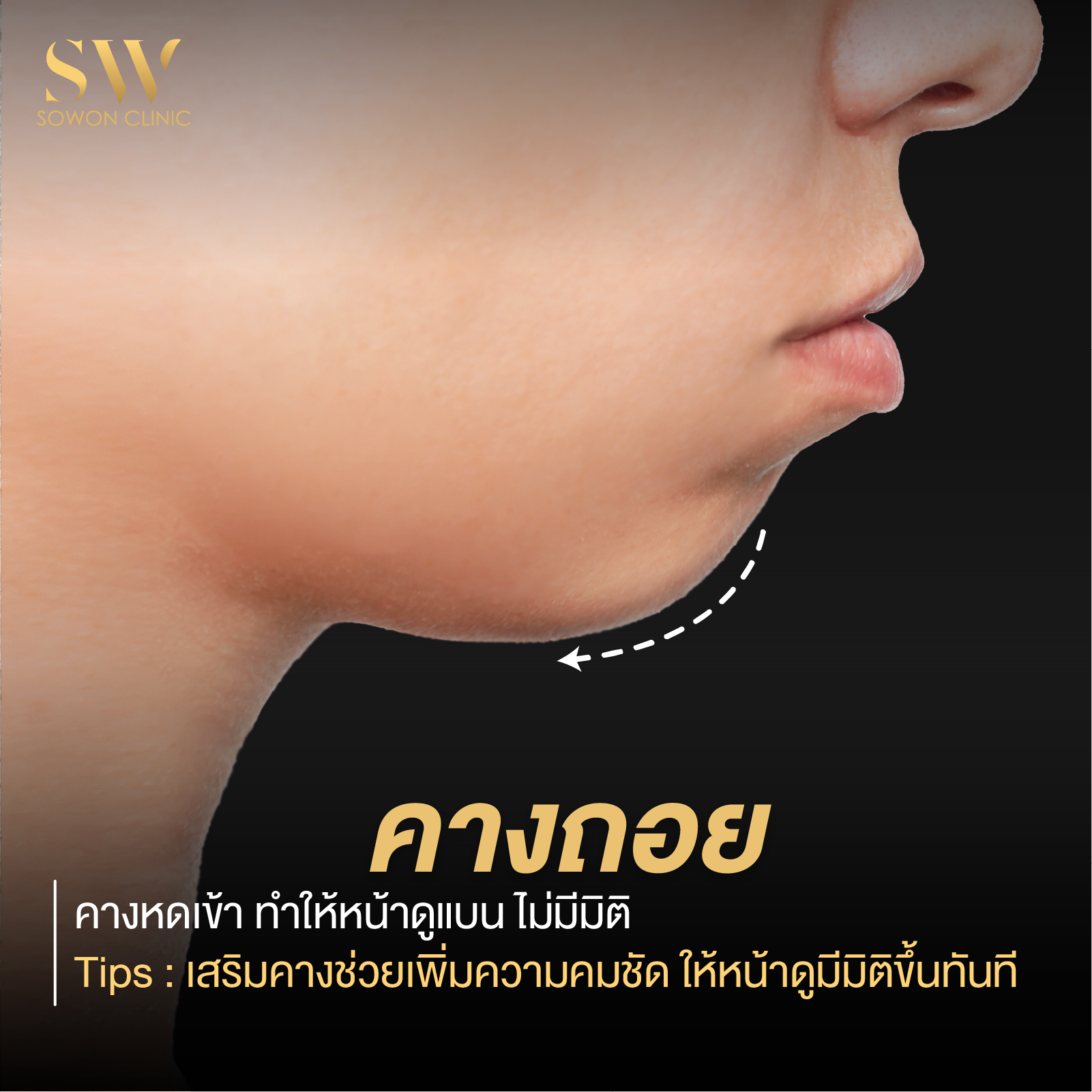 เสริมคาง ถอย