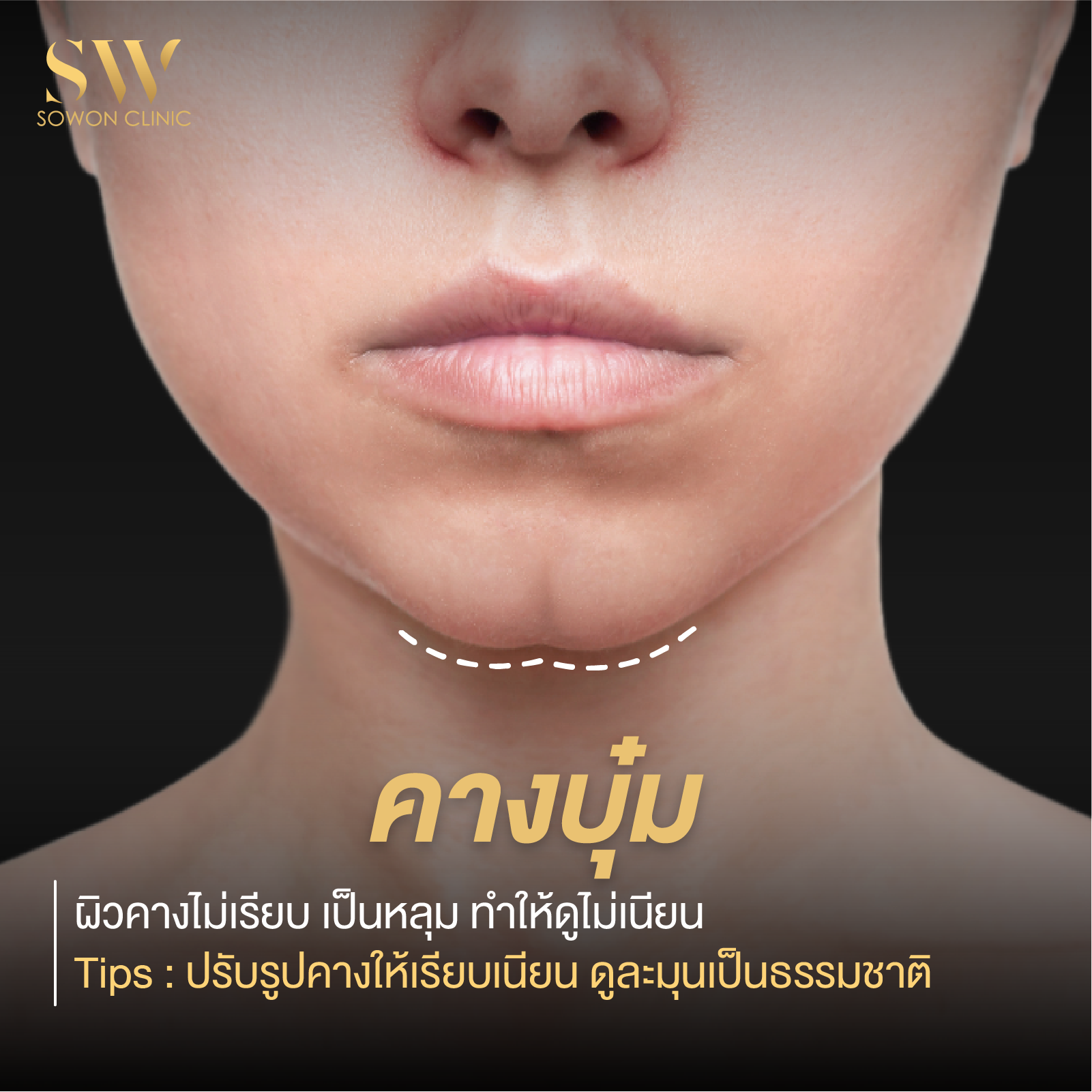 เสริมคาง คางบุ๋ม