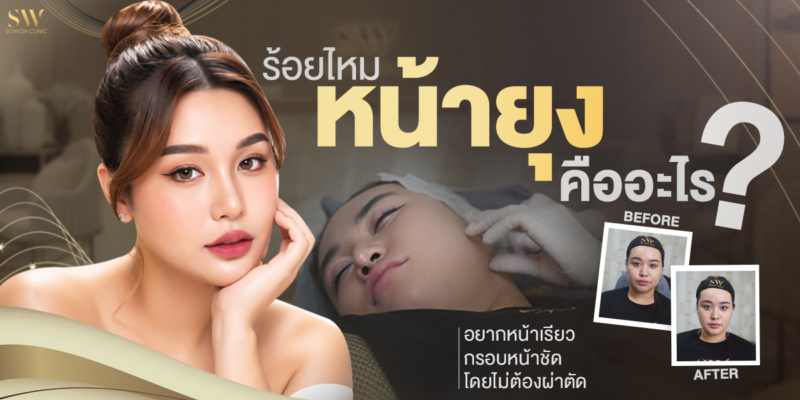 ร้อยไหมหน้ายุง คือ